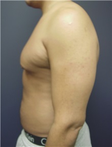 Liposuction Before Photo by Emily Pollard, MD; Ardmore, PA - Case 9709