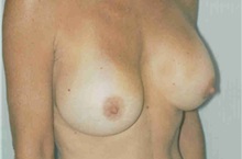 Breast Augmentation After Photo by Susan Kaweski, MD; La Mesa, CA - Case 7767