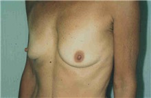 Breast Augmentation Before Photo by Susan Kaweski, MD; La Mesa, CA - Case 7767
