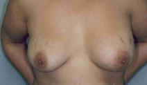 Breast Augmentation After Photo by Susan Kaweski, MD; La Mesa, CA - Case 7768