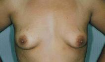 Breast Augmentation Before Photo by Susan Kaweski, MD; La Mesa, CA - Case 7768