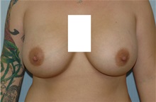 Breast Augmentation After Photo by Susan Kaweski, MD; La Mesa, CA - Case 7769
