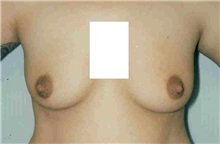 Breast Augmentation Before Photo by Susan Kaweski, MD; La Mesa, CA - Case 7769