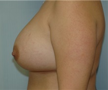Breast Augmentation After Photo by Susan Kaweski, MD; La Mesa, CA - Case 7769