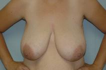 Breast Reduction Before Photo by Susan Kaweski, MD; La Mesa, CA - Case 7770