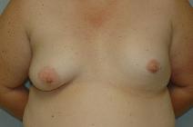 Breast Reconstruction Before Photo by Susan Kaweski, MD; La Mesa, CA - Case 7771