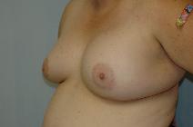 Breast Reconstruction After Photo by Susan Kaweski, MD; La Mesa, CA - Case 7771