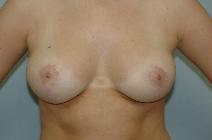 Breast Reduction After Photo by Susan Kaweski, MD; La Mesa, CA - Case 7773