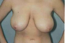 Breast Reduction Before Photo by Susan Kaweski, MD; La Mesa, CA - Case 7773