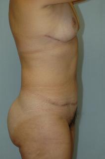 Tummy Tuck After Photo by Susan Kaweski, MD; La Mesa, CA - Case 7775