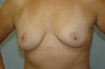 Breast Lift After Photo by Susan Kaweski, MD; La Mesa, CA - Case 7776
