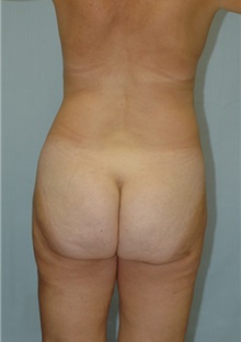 Liposuction After Photo by Susan Kaweski, MD; La Mesa, CA - Case 7777