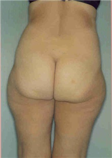 Liposuction Before Photo by Susan Kaweski, MD; La Mesa, CA - Case 7777