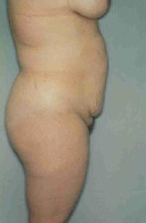 Tummy Tuck Before Photo by Susan Kaweski, MD; La Mesa, CA - Case 7778