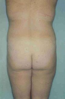 Liposuction After Photo by Susan Kaweski, MD; La Mesa, CA - Case 7779