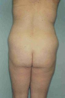 Liposuction Before Photo by Susan Kaweski, MD; La Mesa, CA - Case 7779