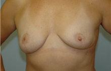 Breast Reduction After Photo by Susan Kaweski, MD; La Mesa, CA - Case 7801