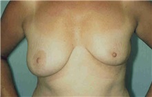 Breast Reduction Before Photo by Susan Kaweski, MD; La Mesa, CA - Case 7801