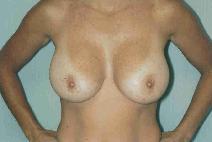 Breast Augmentation After Photo by Susan Kaweski, MD; La Mesa, CA - Case 7960