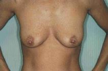 Breast Augmentation Before Photo by Susan Kaweski, MD; La Mesa, CA - Case 7960