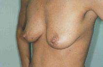 Breast Augmentation Before Photo by Susan Kaweski, MD; La Mesa, CA - Case 7960