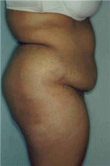 Liposuction Before Photo by Susan Kaweski, MD; La Mesa, CA - Case 7997