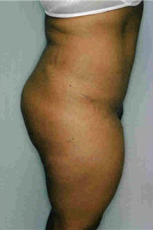 Tummy Tuck After Photo by Susan Kaweski, MD; La Mesa, CA - Case 7998