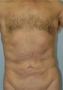 Male Breast Reduction After Photo by Susan Kaweski, MD; La Mesa, CA - Case 8000