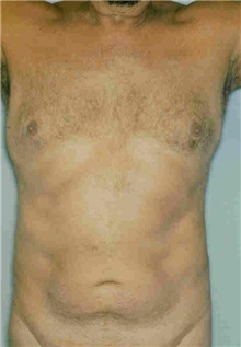 Male Breast Reduction Before Photo by Susan Kaweski, MD; La Mesa, CA - Case 8000