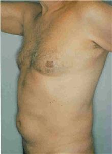 Male Breast Reduction Before Photo by Susan Kaweski, MD; La Mesa, CA - Case 8000