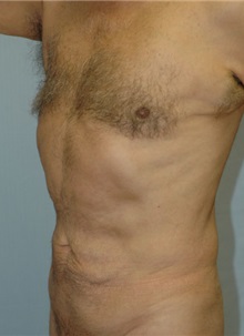 Liposuction After Photo by Susan Kaweski, MD; La Mesa, CA - Case 8001