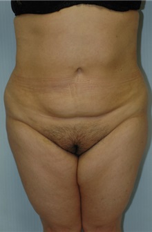 Liposuction After Photo by Susan Kaweski, MD; La Mesa, CA - Case 8010