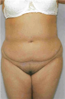 Liposuction Before Photo by Susan Kaweski, MD; La Mesa, CA - Case 8010