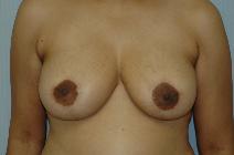 Breast Reduction After Photo by Susan Kaweski, MD; La Mesa, CA - Case 8012