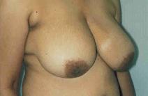 Breast Reduction Before Photo by Susan Kaweski, MD; La Mesa, CA - Case 8012