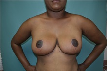 Breast Reduction After Photo by Susan Kaweski, MD; La Mesa, CA - Case 49736 Breast Reduction After Photo by Susan Kaweski, MD; La Mesa, CA - Case 49736
