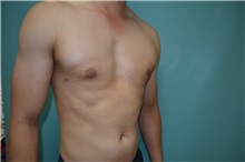 Male Breast Reduction After Photo by Susan Kaweski, MD; La Mesa, CA - Case 49743 Male Breast Reduction After Photo by Susan Kaweski, MD; La Mesa, CA - Case 49743