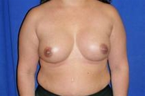 Breast Augmentation After Photo by Bahram Ghaderi, MD, FACS; St. Charles, IL - Case 21690