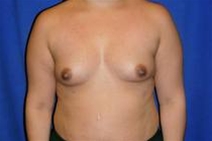 Breast Augmentation Before Photo by Bahram Ghaderi, MD, FACS; St. Charles, IL - Case 21690