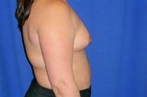 Breast Augmentation Before Photo by Bahram Ghaderi, MD, FACS; St. Charles, IL - Case 21690