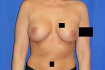 Breast Augmentation After Photo by Bahram Ghaderi, MD, FACS; St. Charles, IL - Case 21691