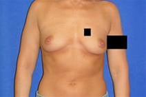 Breast Augmentation Before Photo by Bahram Ghaderi, MD, FACS; St. Charles, IL - Case 21691