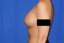 Breast Augmentation After Photo by Bahram Ghaderi, MD, FACS; St. Charles, IL - Case 21691