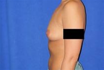 Breast Augmentation Before Photo by Bahram Ghaderi, MD, FACS; St. Charles, IL - Case 21691