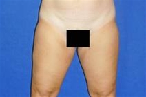 Liposuction After Photo by Bahram Ghaderi, MD, FACS; ,  - Case 21724
