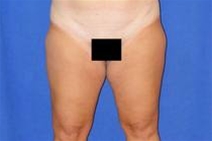 Liposuction Before Photo by Bahram Ghaderi, MD, FACS; ,  - Case 21724