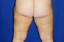 Liposuction After Photo by Bahram Ghaderi, MD, FACS; ,  - Case 21724