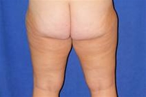 Liposuction Before Photo by Bahram Ghaderi, MD, FACS; ,  - Case 21724