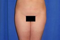 Liposuction After Photo by Bahram Ghaderi, MD, FACS; St. Charles, IL - Case 21730