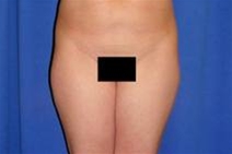 Liposuction Before Photo by Bahram Ghaderi, MD, FACS; St. Charles, IL - Case 21730